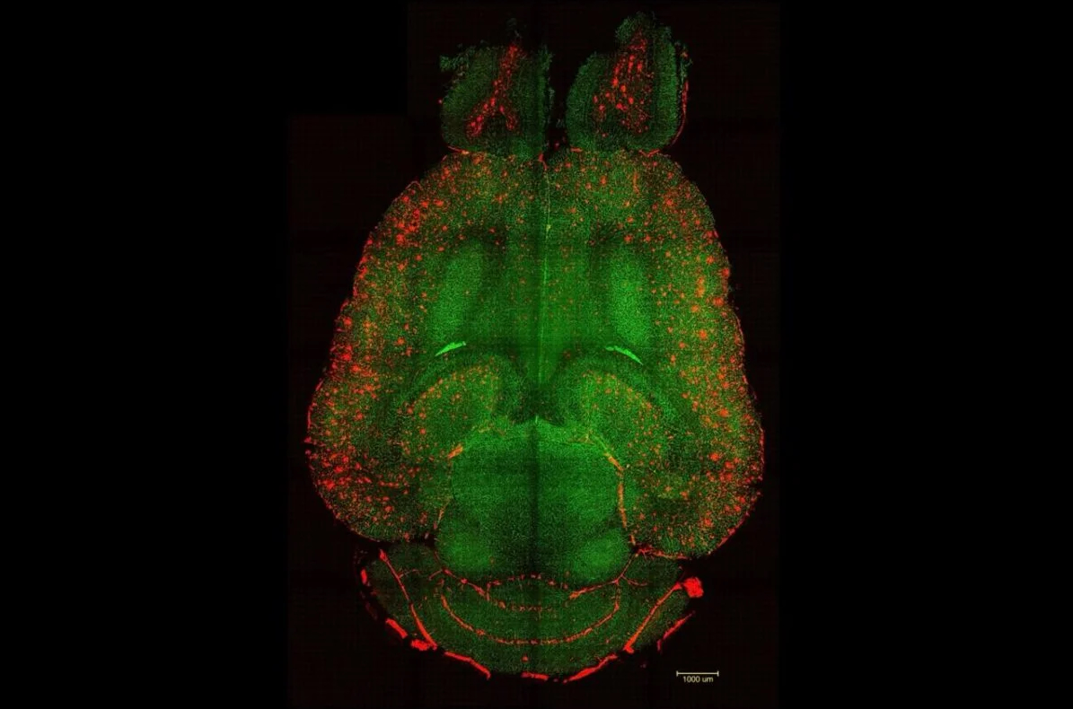 Suíça: nanofiltro sanguíneo remove proteínas da doença de Alzheimer em poucas horas, revertendo a demência  - Jornal O São Paulo
